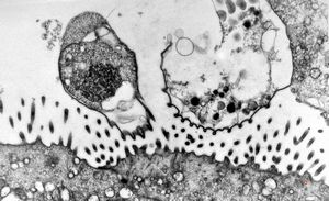 M,33y. | cryptosporidiosis - duodenum, im | munodeficient pacient M,33y. | cryptosporidiosis - duodenum, im | munodeficient pacient